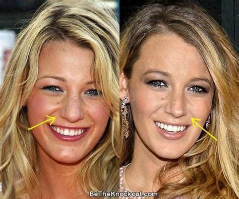 blake lively silicone|Celebrities Who Have Had A Breast Augmentation